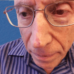 Mohs Nose Patient 12 Thumbnail Before