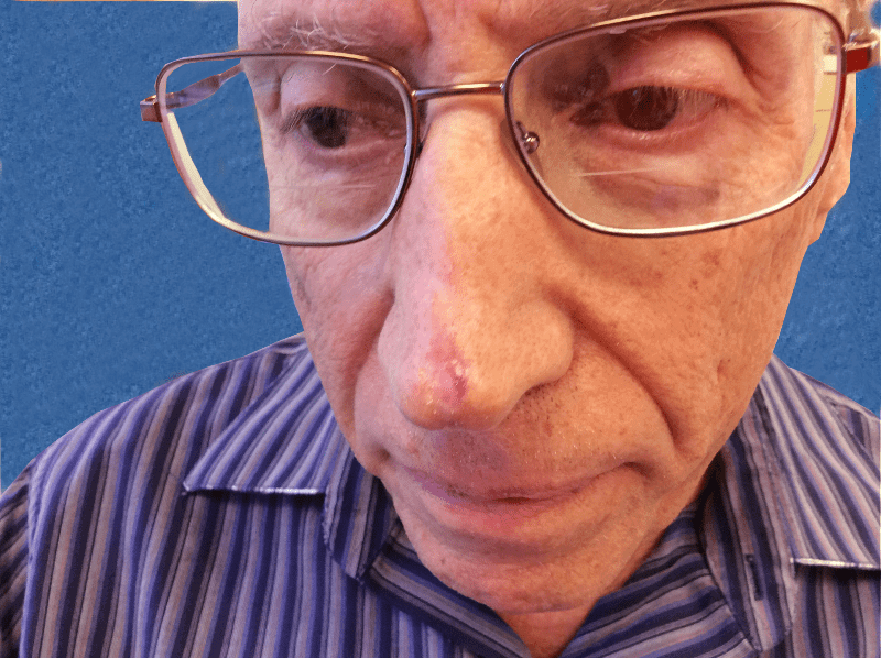 Mohs Nose Patient 12 Before