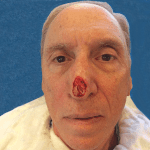 Mohs Nose Patient 12 Thumbnail After
