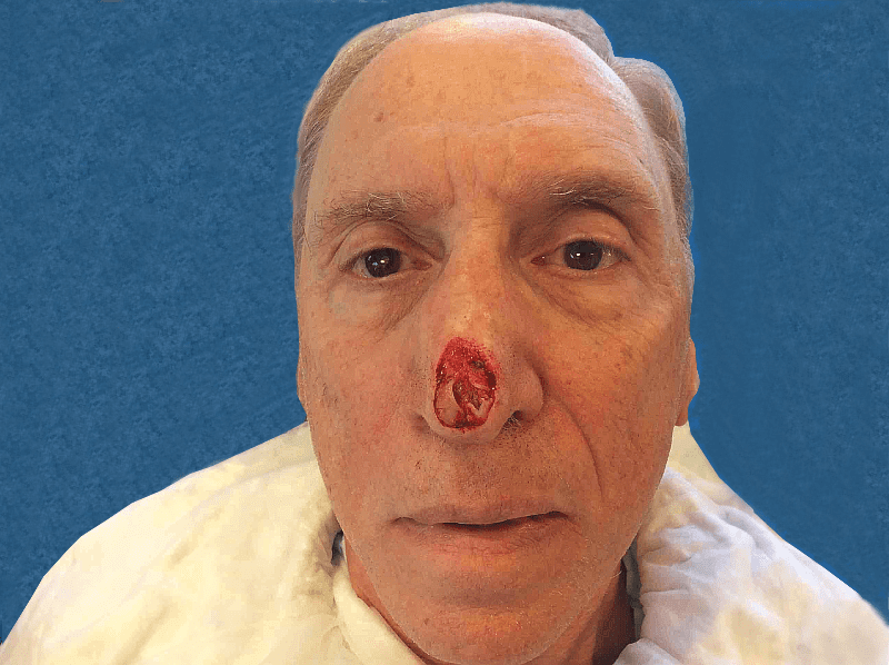 Mohs Nose Patient 12 After