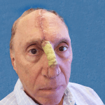 Mohs Nose Patient 12 Thumbnail Before - 2