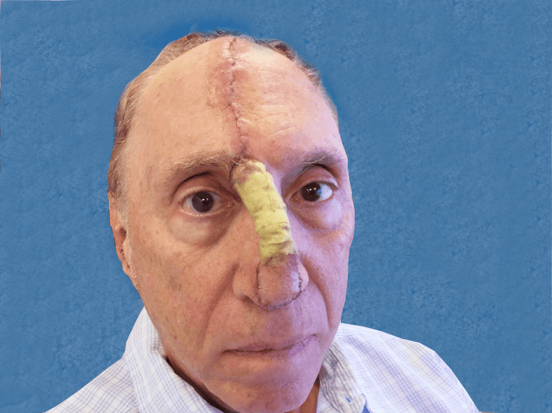 Mohs Nose Patient 12 Before - 2