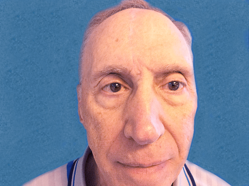 Mohs Nose Patient 12 After - 2