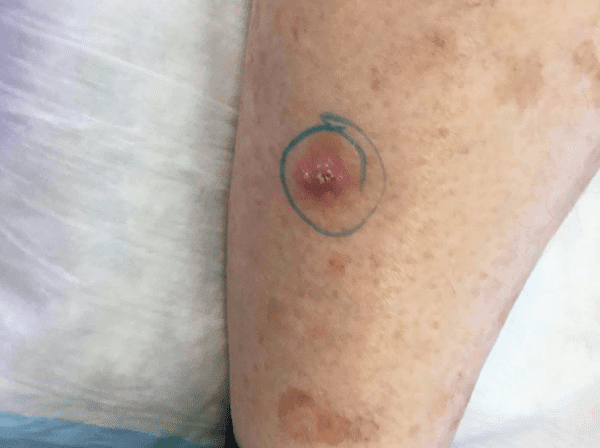 Mohs Leg Patient 01 Before