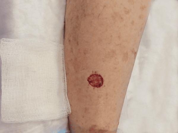 Mohs Leg Patient 01 After