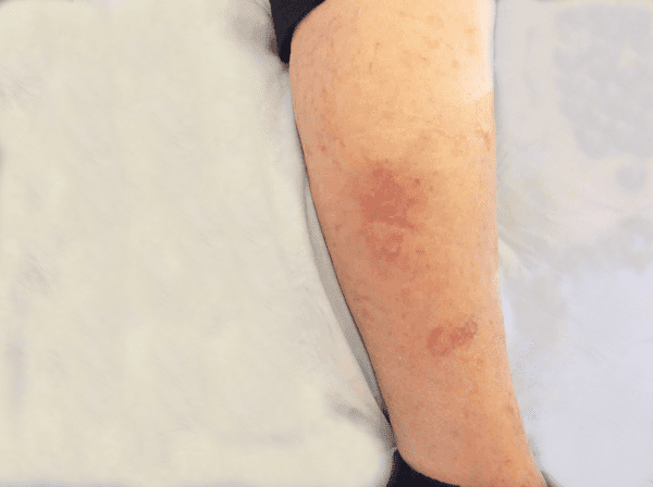 Mohs Leg Patient 01 After - 2