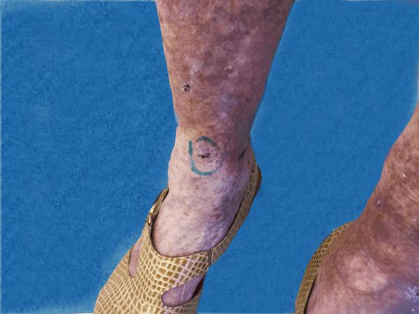 Mohs Leg Patient 02 Before