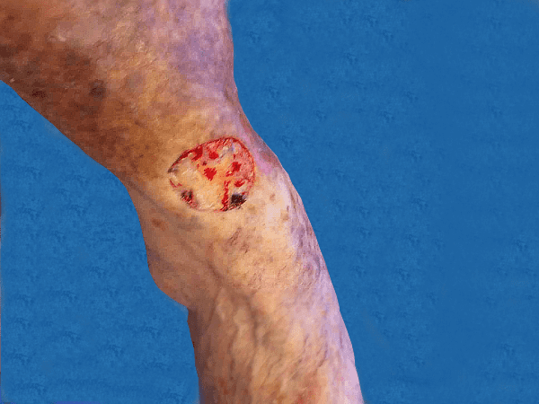 Mohs Leg Patient 02 After