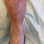 Mohs Leg Patient 02 Thumbnail After - 2