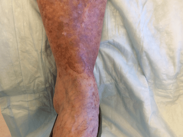 Mohs Leg Patient 02 After - 2