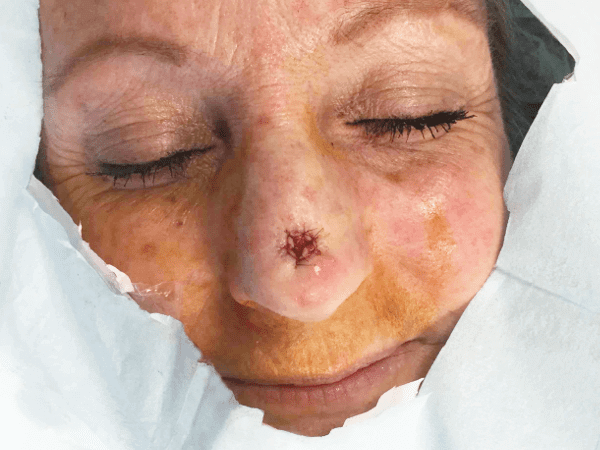 Mohs Nose Patient 16 Before - 2