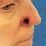 Mohs Nose Patient 14 Thumbnail Before