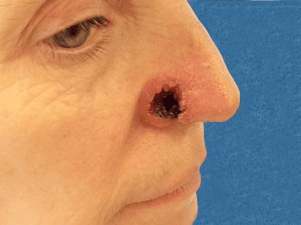 Mohs Nose Patient 14 Before