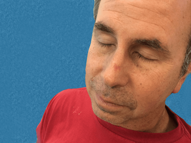 Mohs Nose Patient 17 Before