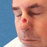 Mohs Nose Patient 17 Thumbnail After