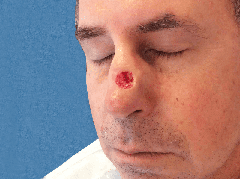 Mohs Nose Patient 17 After