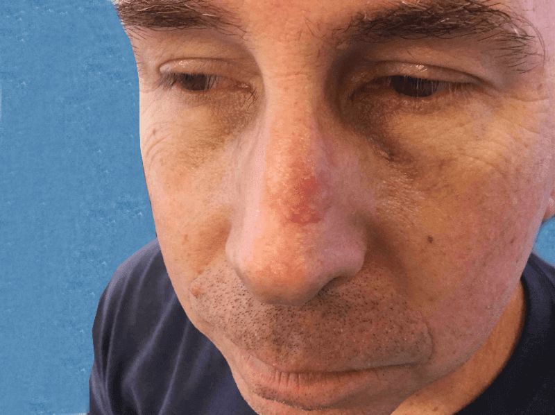 Mohs Nose Patient 17 Before - 2