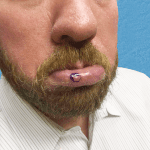 Mohs Lips Patient 04 Thumbnail Before