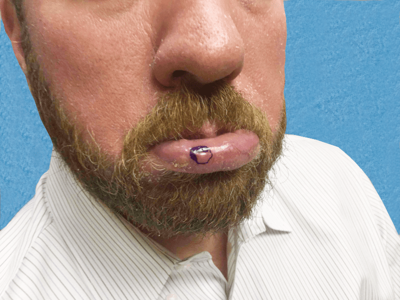 Mohs Lips Patient 04 Before