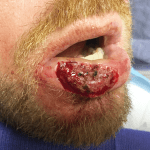 Mohs Lips Patient 04 Thumbnail After