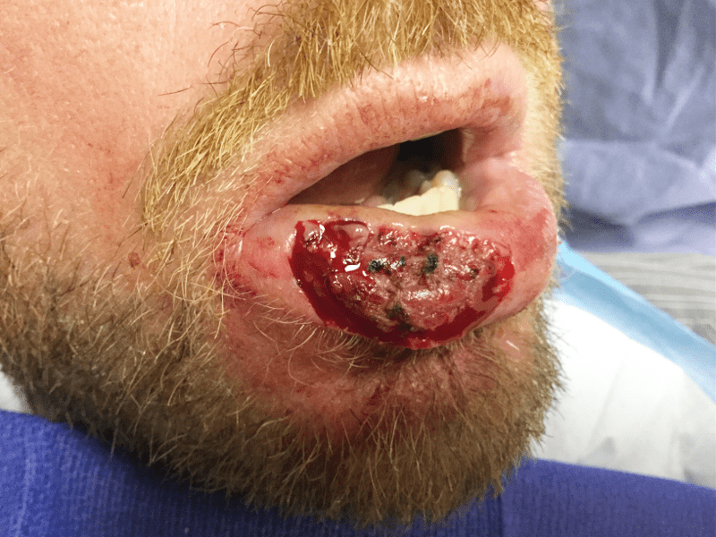 Mohs Lips Patient 04 After