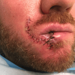 Mohs Lips Patient 04 Thumbnail Before - 2