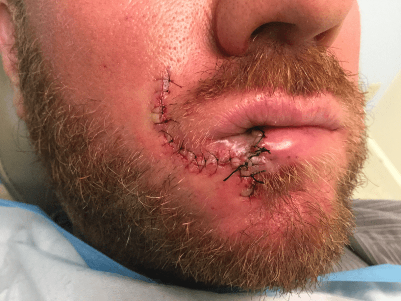 Mohs Lips Patient 04 Before - 2