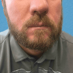 Mohs Lips Patient 04 Thumbnail After - 2