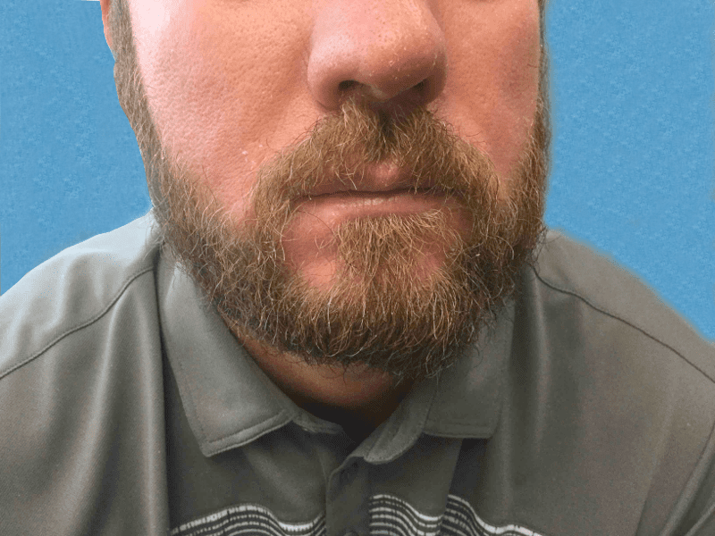 Mohs Lips Patient 04 After - 2