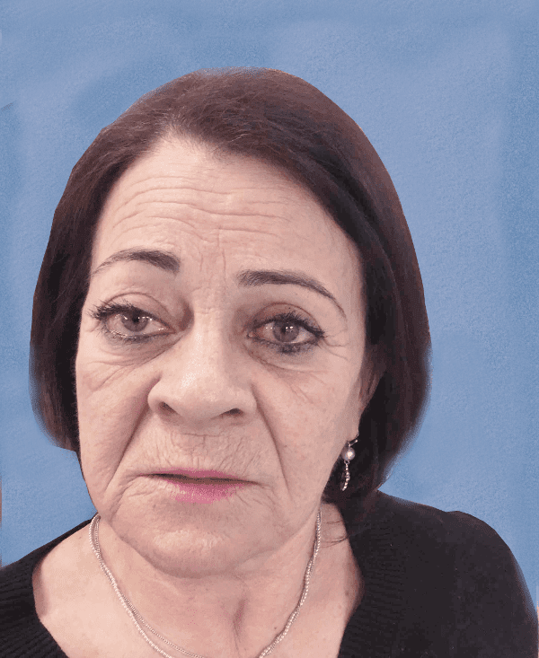 Facelift Patient 03 Before