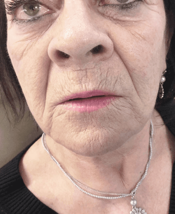 Facelift Patient 03 After