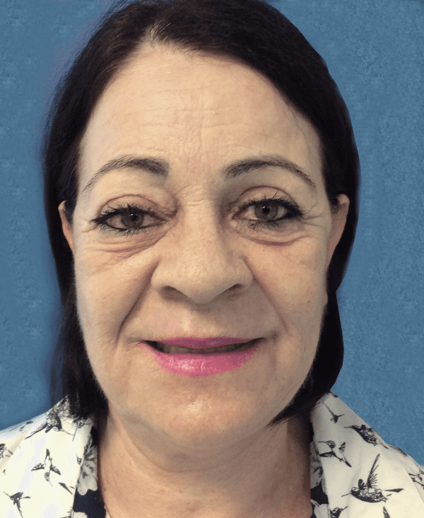 Facelift Patient 03 After - 2