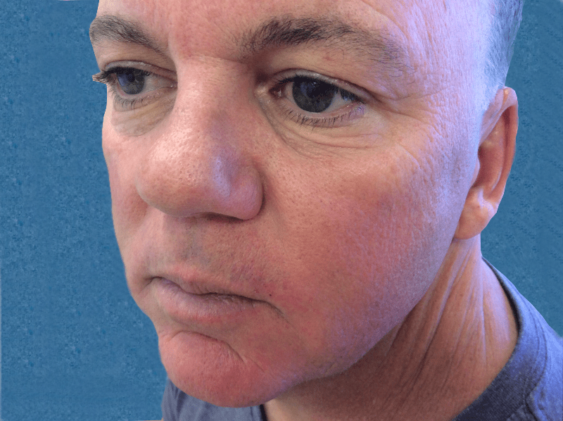 Mohs Lips Patient 06 Before