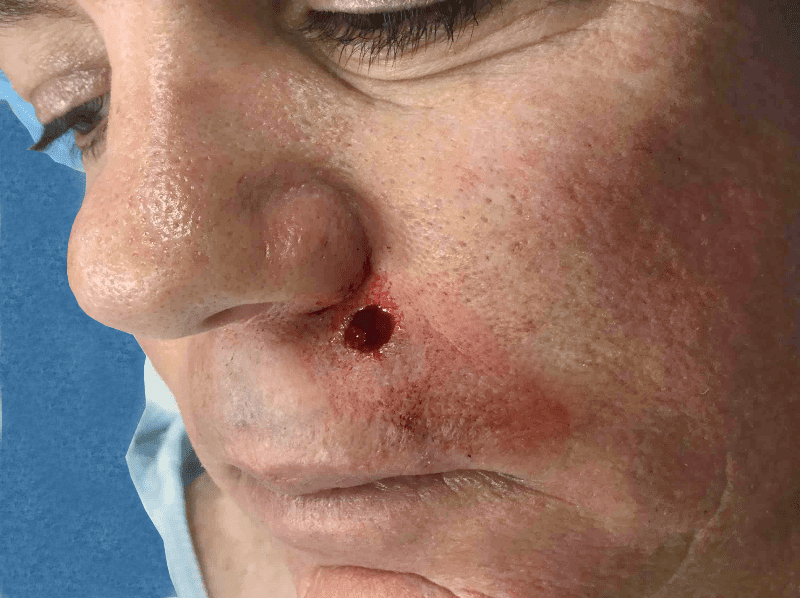 Mohs Lips Patient 06 After