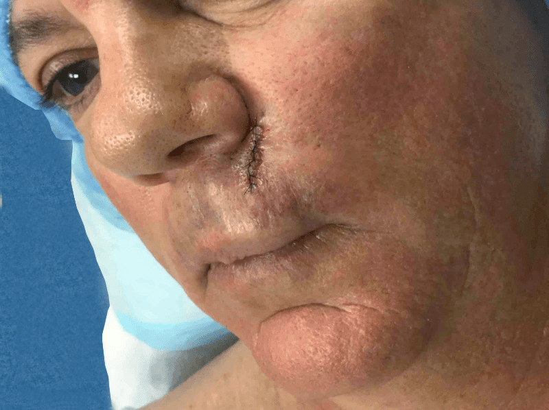 Mohs Lips Patient 06 Before - 2