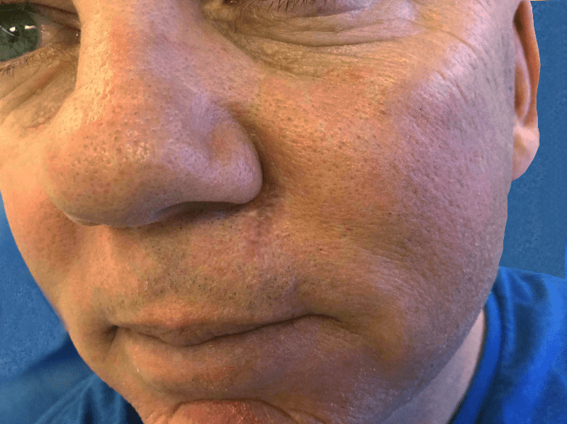 Mohs Lips Patient 06 After - 2