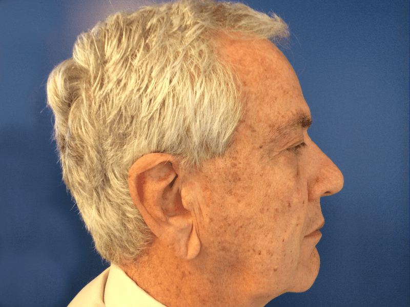 Blepharoplasty Patient 03 After