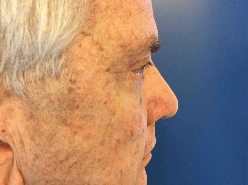 Blepharoplasty Patient 03 After - 2