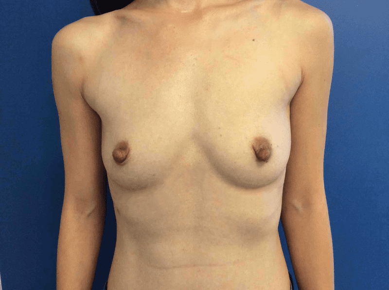 Breast Augmentation Patient 01 Before