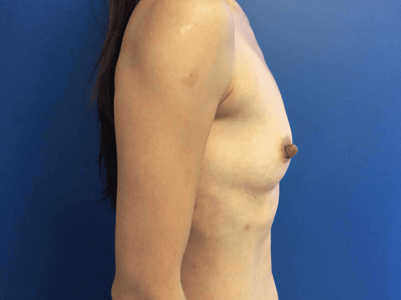 Breast Augmentation Patient 01 After
