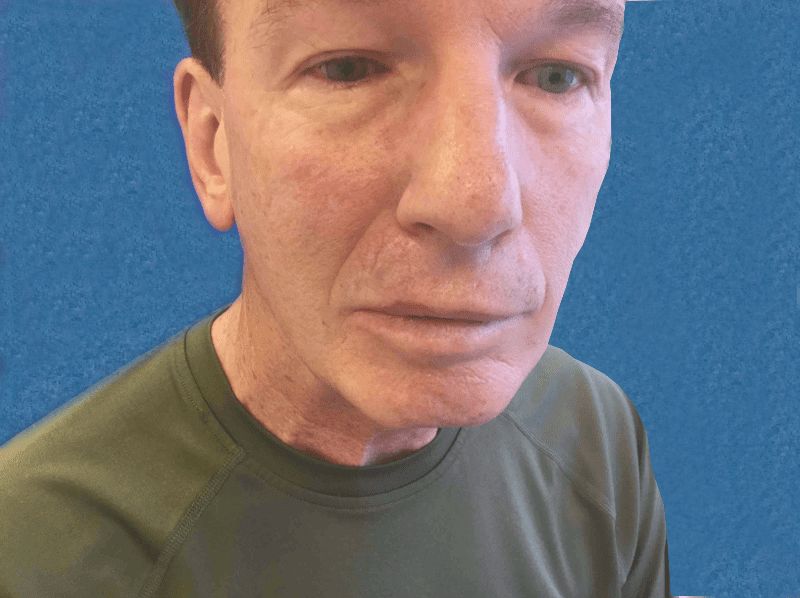 Mohs Lips Patient 05 After - 2