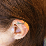 Mohs Ear Patient 05 Thumbnail Before