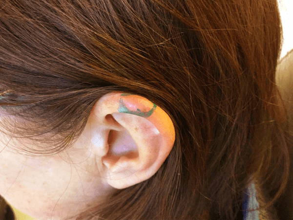 Mohs Ear Patient 05 Before