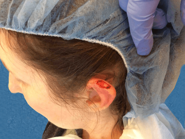 Mohs Ear Patient 05 After