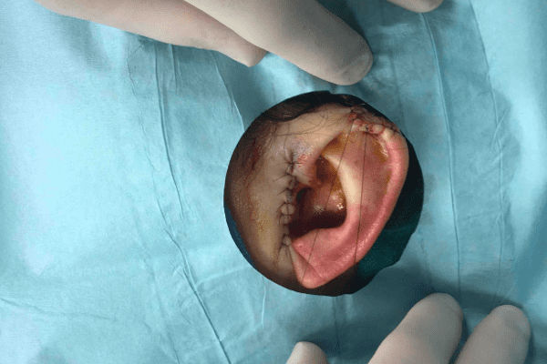 Mohs Ear Patient 05 Before - 2