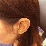 Mohs Ear Patient 05 Thumbnail After - 2