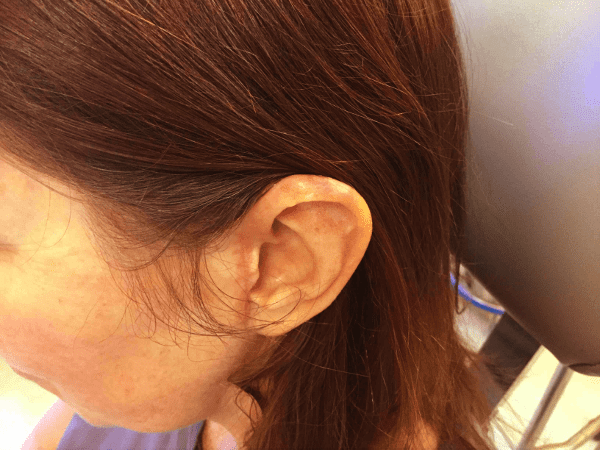 Mohs Ear Patient 05 After - 2