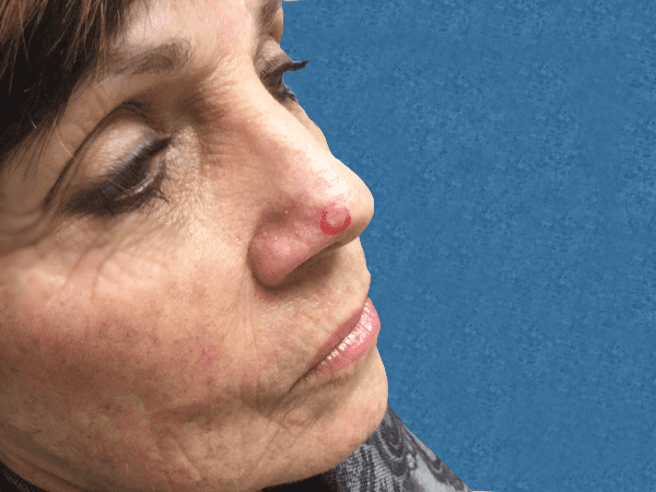 Mohs Nose Patient 18 Before