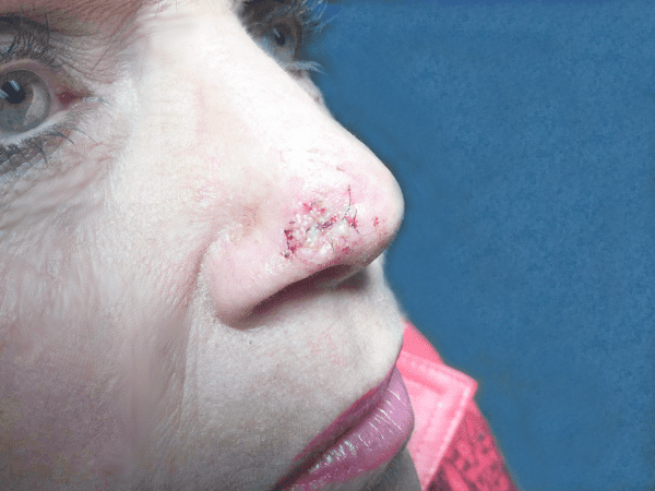 Mohs Nose Patient 18 After