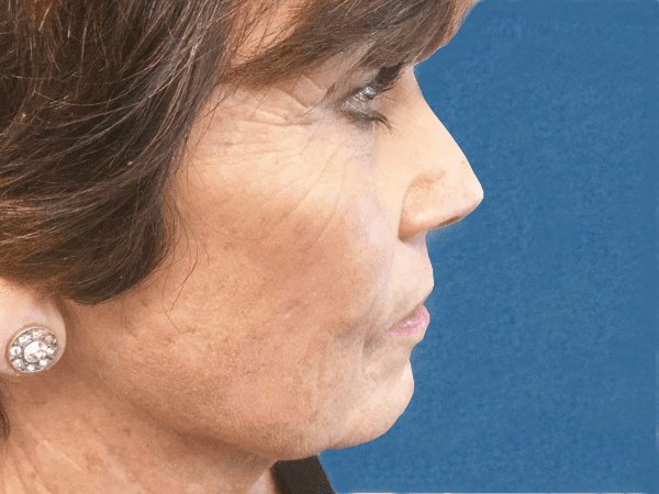 Mohs Nose Patient 18 Before - 2